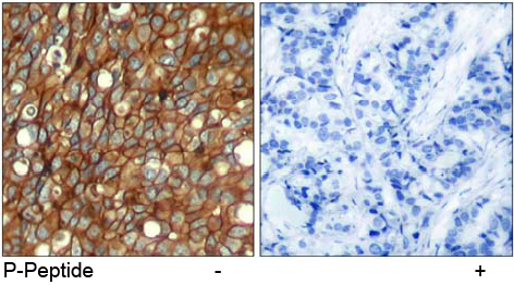 Rabbit Anti HER2 (Phospho-Tyr1248) (polyclonal) Immunohistochemical analysis Rabbit Anti HER2 (Phospho-Tyr1248) (polyclonal) Immunohistochemical analysis
