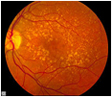 Age-related Macular Degeneration