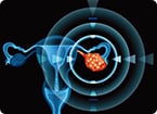 ovarian cancer, ovarian tumor, toxoplasma gondii, effector proteins, immunotherapy