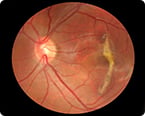 retinal regeneration