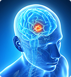 glioblastoma