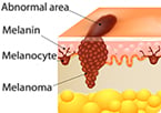 p15 tumor suppressor protein in skin moles prevents progression to melanoma