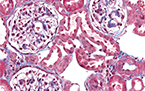 renal fibrosis can be reversed by inhibiting EMT genes