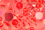 multiple myeloma