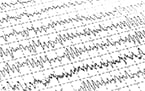 REM sleep, beta-amyloid
