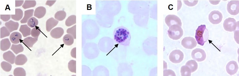 Different forms of P. falciparum in a blood smear