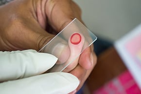 Example of blood film  for malaria