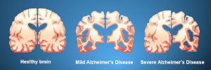 Biogen's Antibody for Alzheimer's Disease