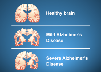Biogen's Antibody for Alzheimer's Disease