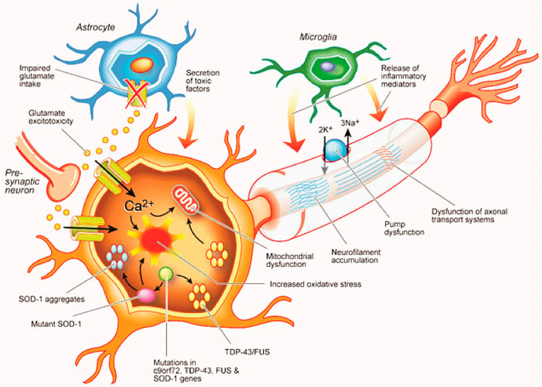 Amyotrophic lateral sclerosis