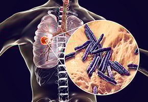 Mycobacterium tuberculosis (Mtb) picture