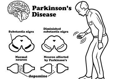 Molecular mechanism behind slowed progression of Parkinson’s disease due to exercise discovered