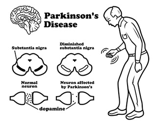 Parkinson’s, neurodegenerative disease, brain cells, alpha-synuclein, brain cell death, brain disease