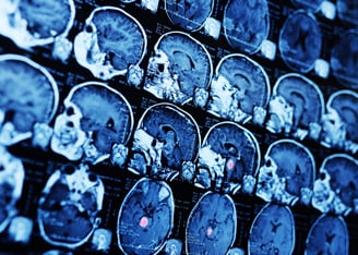 Neoantigen Peptides for Personalized T Cell Immunotherapies in Brain Cancer
