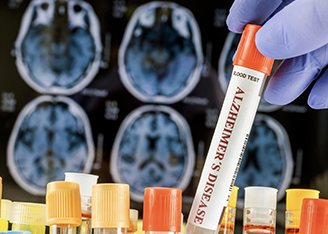 New Alzheimer's Biomarkers may Support Early Diagnosis