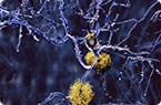 Tau protein, Alzheimer's