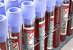 HIV