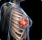 breast cancer, estrogen receptor, XPO1, nuclear transport, tamoxifen, selinexor, ERK5
