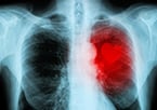 heart disease