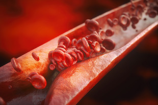 heart disease, atherosclerosis, plaque, bacterial fats, blood vessel, diet
